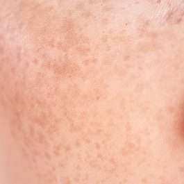 freckles
