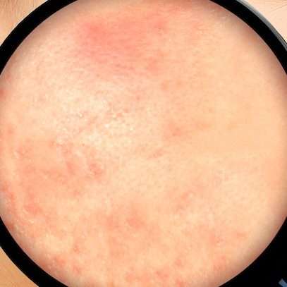 rosacea