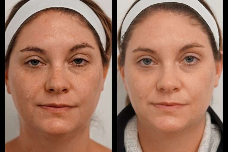 Heos before after (1)