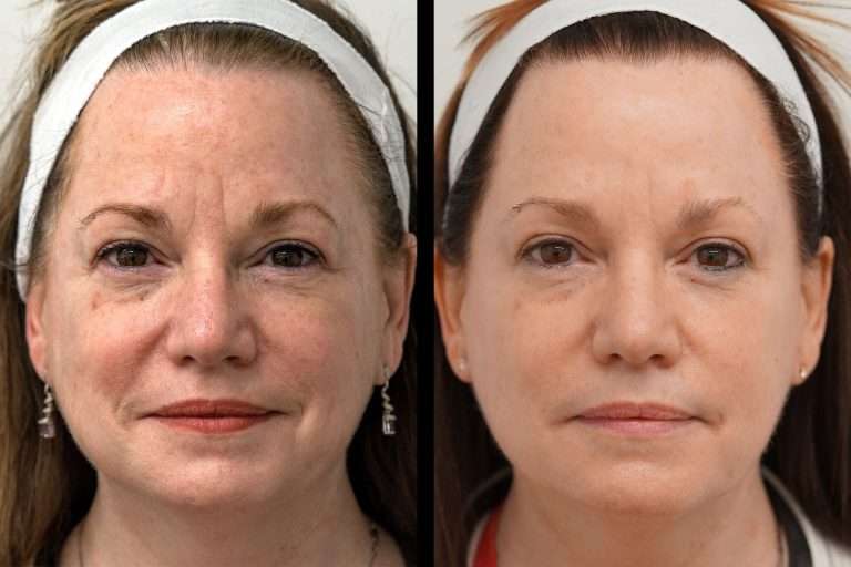Heos before after