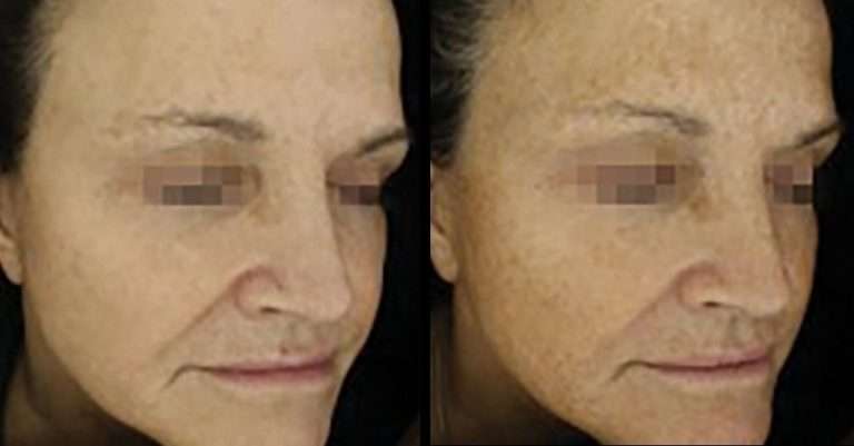 heos before and after 2